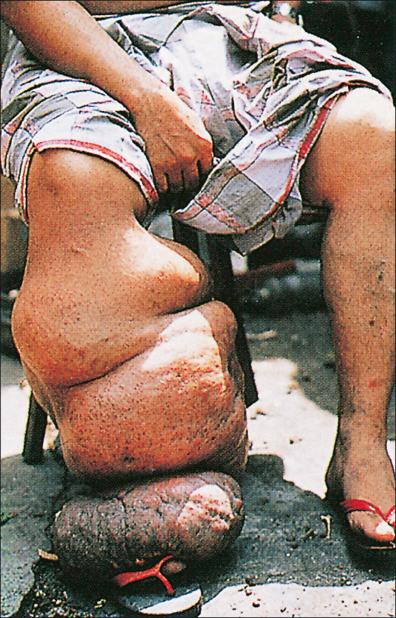 Figure 7-3, Massive elephantiasis due to Brugia malayi .