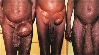 Figure 7-4, Hanging groin and scrotal elephantiasis due to onchocerciasis.