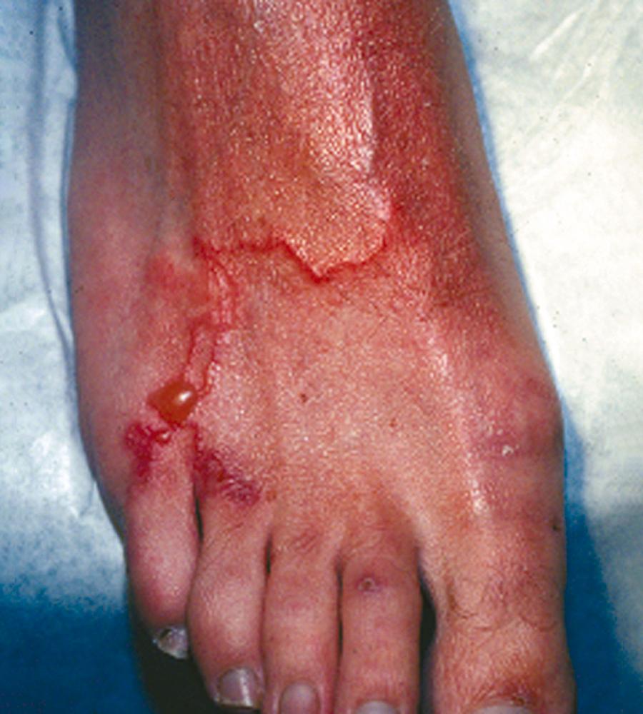 FIGURE 327-3, Typical lesion of cutaneous larva migrans.