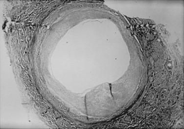 FIG 58.1, Photomicrograph of a failed infrainguinal autogenous vein bypass graft showing a large amount of hyperplastic intimal proliferation (Verhoeff–van Gieson stain; original magnification ×20).