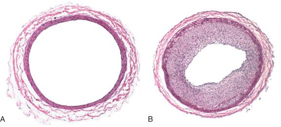 FIG 58.2, (A) Cross section of a rat carotid artery. (B) Cross section of a rat carotid artery 2 weeks after balloon injury.