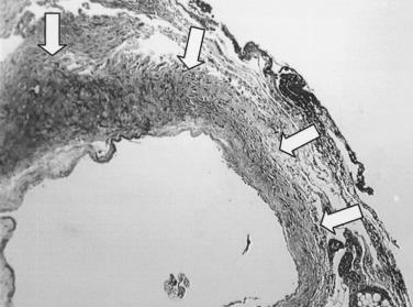 FIG 58.3, Trichrome-elastin stain of a 72-hour-old vein graft. The luminal side is depicted on the bottom edge of this tissue section. There is evidence of endothelial and smooth muscle cell denudation, with adherence of leukocytes and platelets.