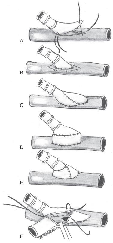 FIG 58.5, Surgical techniques using vein interposition for creation of distal anastomoses. (A) Standard end-to-side anastomosis, (B) Linton patch, (C) Taylor patch, (D) Miller cuff, (E) St. Mary's vein boot, and (F) arteriovenous fistula.