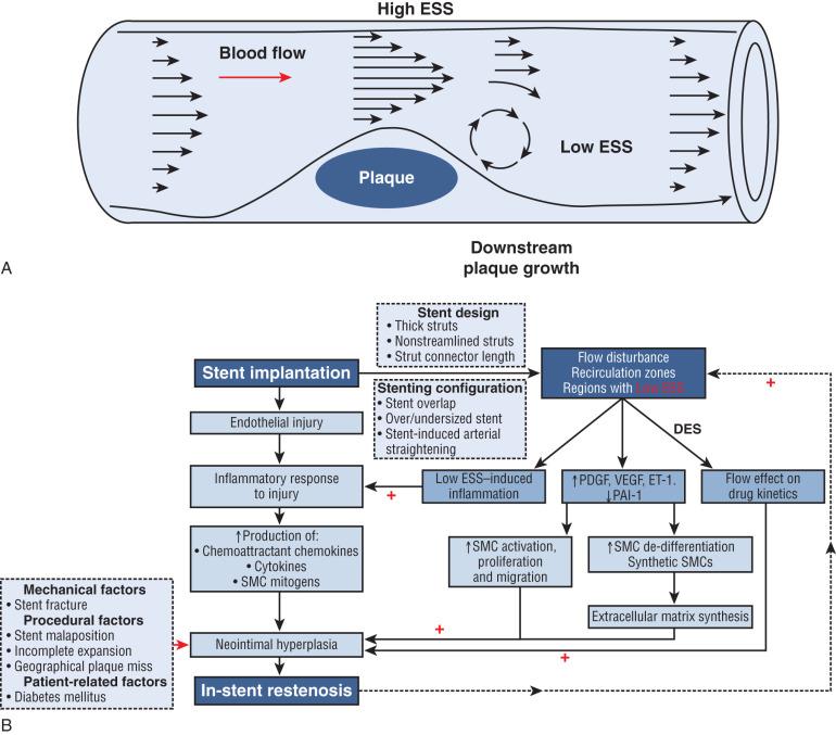 FIG 58.6, Model of low endothelial shear stress (ESS) in native atherosclerotic plaque and in stented lesions. (A) Model of blood flow around native atherosclerotic plaque with low ESS due to hemodynamic disturbance downstream from the plaque. (B) Schematic flow model depicting the relationship between low ESS and restenosis. DES , Drug-eluting stent; SMC , smooth muscle cell.