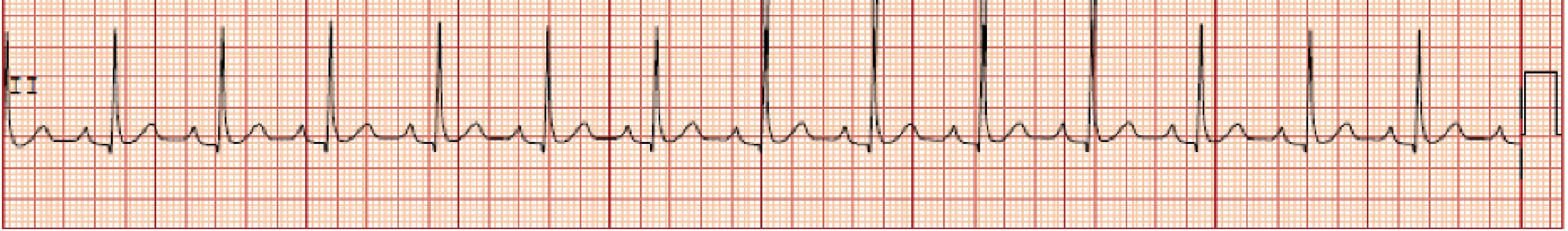 Fig. 39.2, First-Degree Block With Sinus Rhythm (PR Interval Measures Approximately 200 ms).