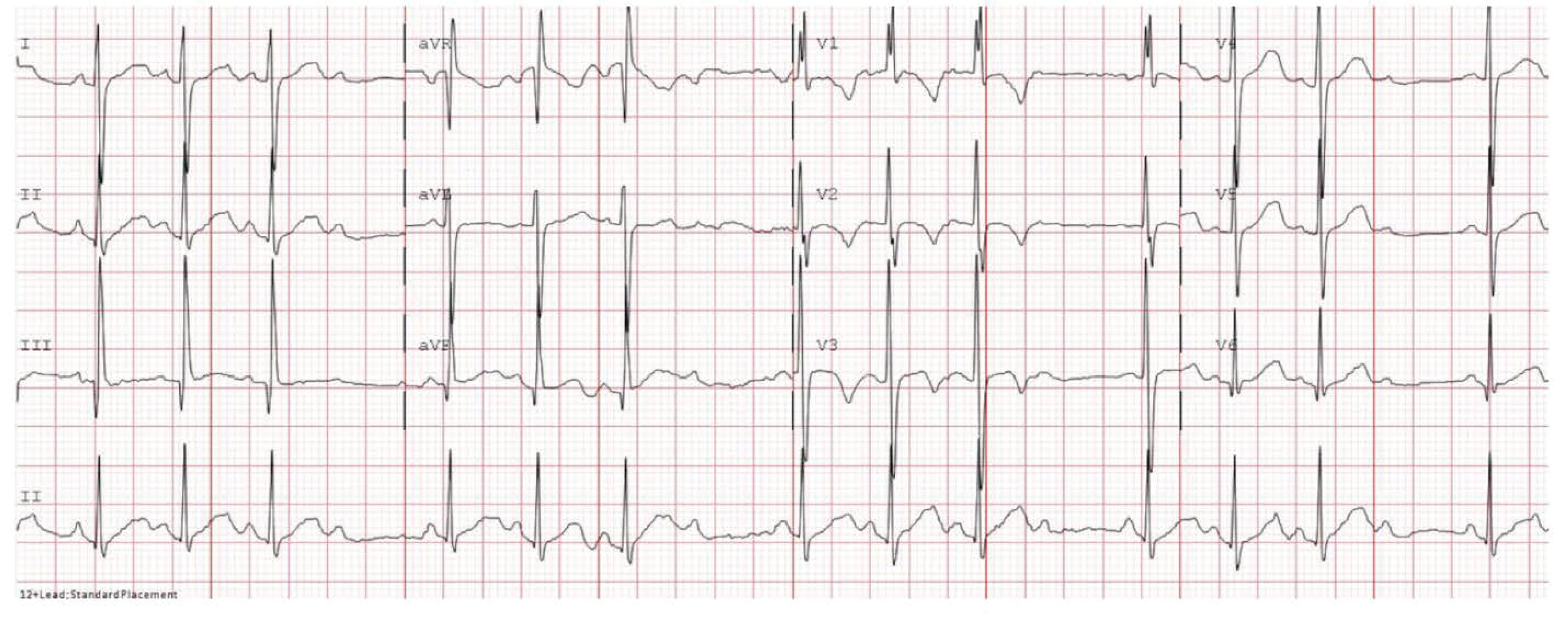 Fig. 39.3, Second-Degree Atrioventricular Block, Type I Wenckebach, With Small Prolongations of the PR Intervals Occurring Prior to a Dropped QRS.