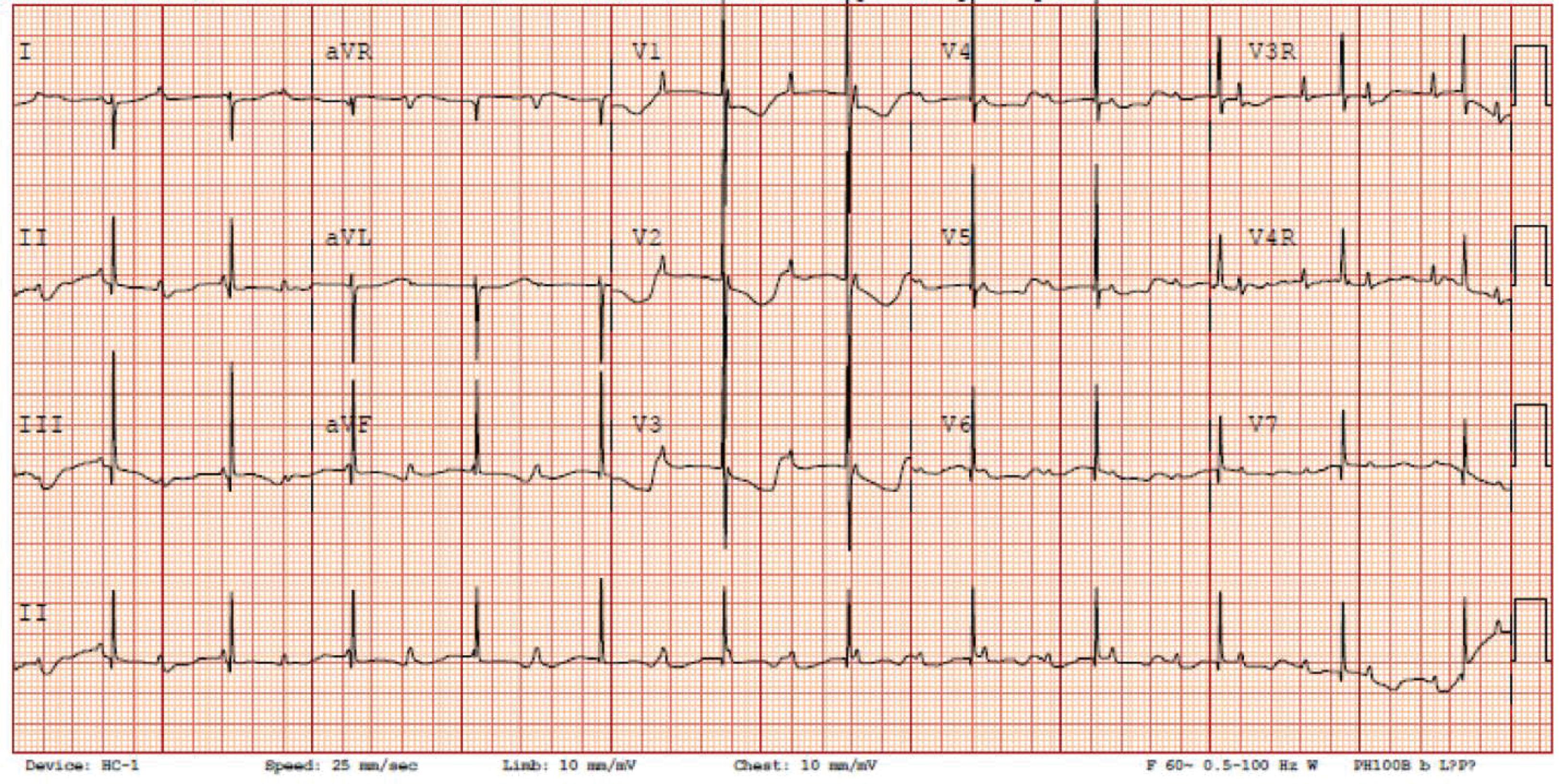 Fig. 39.5, Complete Third-Degree Heart Block With Atrial Rate Nearly Twice the Ventricular Rate.