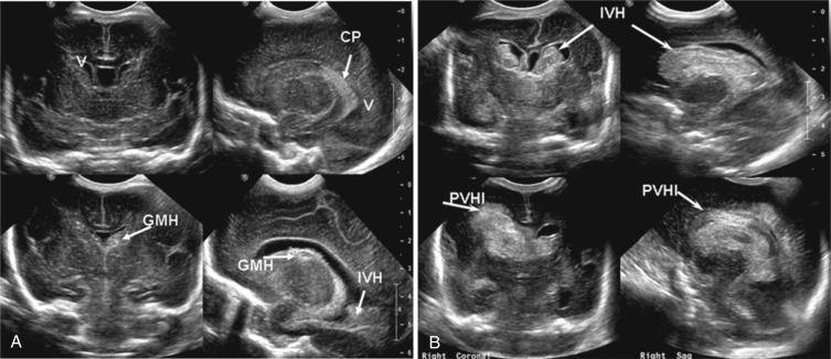 Fig. 17.3, (A) The top panel shows coronal (left) and sagittal (right) views from a normal preterm brain ( V, ventricle; CP, choroids plexus). The bottom panel (left) shows a coronal view with a left germinal matrix hemorrhage (GMH) or grade I. On the right is a sagittal section showing blood in the lateral ventricle (intraventricular hemorrhage [ IVH] ) and filling less than 50% of the ventricular space; grade II germinal matrix hemorrhage/intraventricular hemorrhage. (B) The top panel on the left shows a coronal view of bilateral hemorrhage (IVH) in the anterior ventricles and almost filling the ventricles. On the right is a sagittal view of the hemorrhage or blood cast (IVH) filling and distending the lateral ventricle; grade III hemorrhage. The bottom panel shows on the left a coronal view of hemorrhage with parenchymal involvement (see arrows ) representing periventricular hemorrhagic infarction (PVHI) .