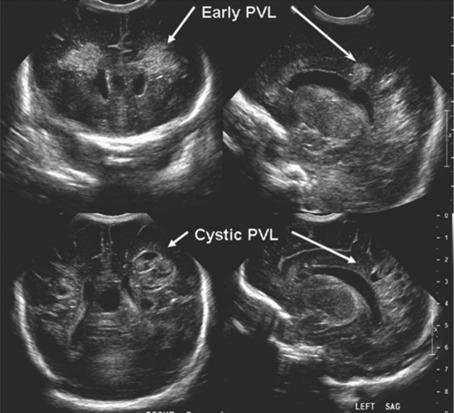 Fig. 17.4, The top panel shows the coronal and sagittal views of early periventricular leukomalacia (PVL) , which appears echodense, as indicated by the arrows. A week later on the same child, the echodense areas have turned into multiples cysts in the periventricular area (cystic periventricular leukomalacia).