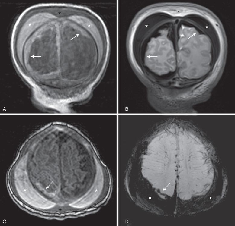 e-Figure 30.2, Caput succedaneum, cephalohematoma, and subdural hematoma in a newborn.