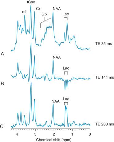 e-Figure 30.5, Magnetic resonance (MR) spectroscopy in hypoxic-ischemic encephalopathy.