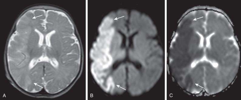 Figure 30.7, Ischemic infarct.