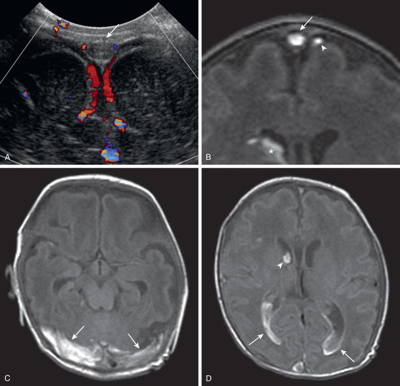 Figure 30.8, Venous sinus thrombosis.