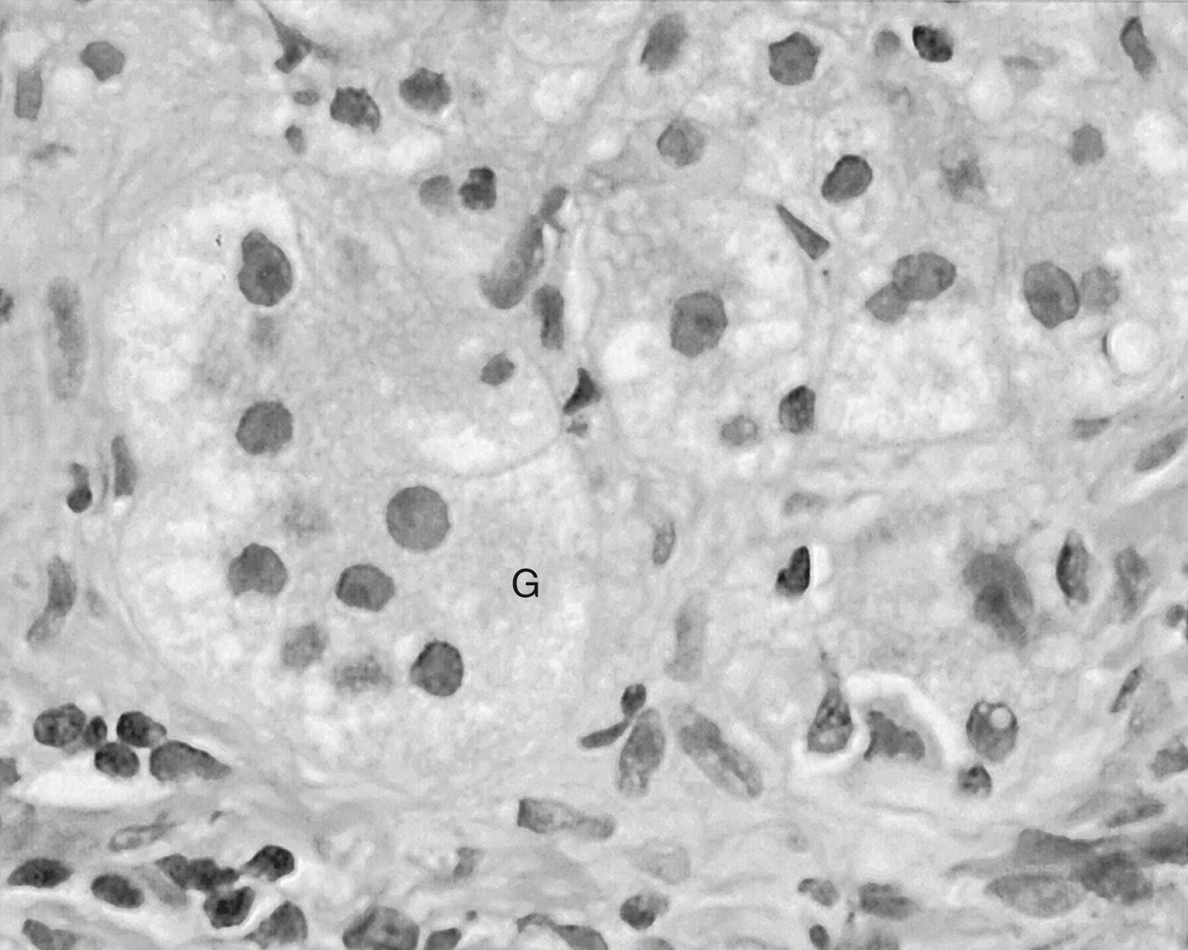 Fig. 68.1, Multinucleated giant cell (G) transformation typical of neonatal hepatitis. (Hematoxylin & eosin, original magnification ×600.)