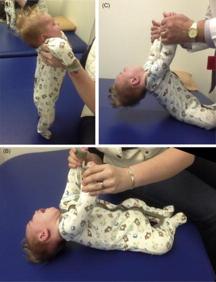 Figure 6.1, Major features of neonatal hypotonia (“floppy infant”). With vertical suspension ( A ), note the dangling lower limbs with lack of hip flexion, tendency of upper limbs to slip through the examiner’s hands, and lack of neck flexion with resulting head lag. When subject is supine, note the lack of traction response ( B ) and the lag of head ( C ) with attempts by examiner to pull infant to sitting position. With horizontal suspension (not shown), the child drapes over the examiner’s hand.