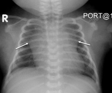 Fig. 18.1, Normal anteroposterior chest radiograph. Wavy appearance of the normal thymic borders (arrows).