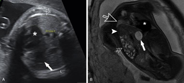 Fig. 18.12, Congenital diaphragmatic hernia. (A) Axial ultrasound shows herniated organs in the left chest with the heart (∗) displaced to the right chest (open arrow) . R, right, L, left. The stomach (white solid arrow) is partially obscured by rib-shadowing artifact. (B) Coronal fetal magnetic resonance imaging through the chest better depicts the herniated left lobe of the liver (arrowhead), fluid-filled small bowel loops (small open arrow), and stomach (solid arrow) adjacent to the very hypoplastic lung (large open arrow) . The heart (∗) is displaced to the right hemothorax.