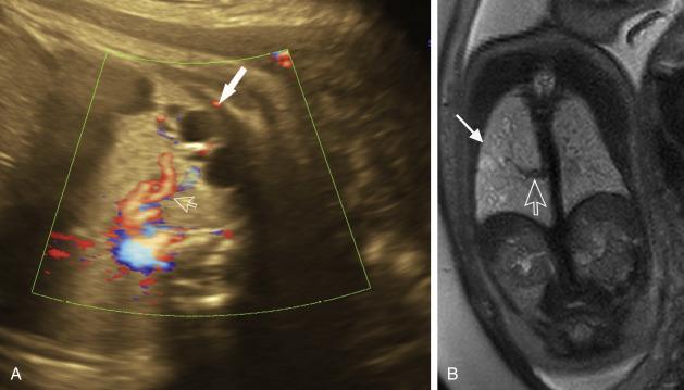 Fig. 18.14, Bronchopulmonary sequestration. (A) Axial ultrasound with Doppler image shows cystic and solid lesion (solid arrow) in the chest with a systemic vessel (open arrow) arising from the aorta. (B) Coronal magnetic resonance imaging image shows mixed solid and cystic lesion (solid arrow) and the systemic vessel arising from the aorta (open arrow).