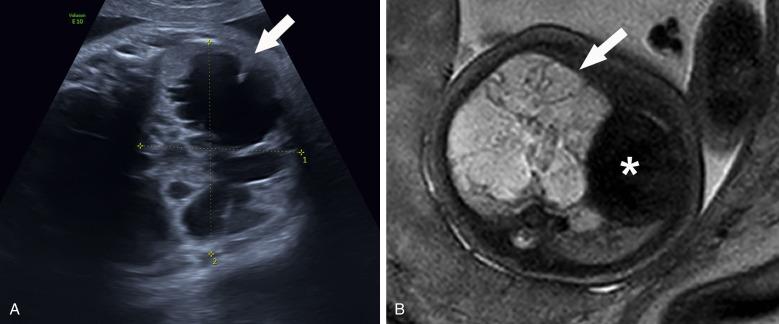 Fig. 18.15, Congenital pulmonary airway malformation. (A) Axial fetal sonographic image shows a lesion with cystic spaces divided by thick septations in half of the thorax (arrow). (B) Axial fetal magnetic resonance imaging image shows the right-sided lesion containing septations and hyperintense fluid (arrow). Leftward displacement of the heart (∗).