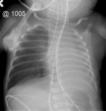 Fig. 18.2, Malposition of the endotracheal tube. Anteroposterior chest radiograph shows the tip of the endotracheal tube in the right main bronchus with left lung atelectasis.