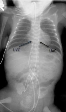 Fig. 18.3, Umbilical venous (UVC) and arterial catheter (UAC) positions on chest/abdominopelvic radiograph.