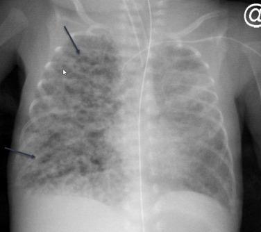 Fig. 18.5, Pulmonary interstitial emphysema. Anteroposterior chest radiograph shows meandering radiolucencies throughout the right lung (arrows).