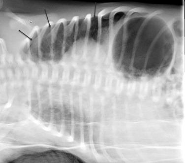 Fig. 18.7, Pneumothorax. Decubitus view of the chest shows radiolucency outlining the left lung.