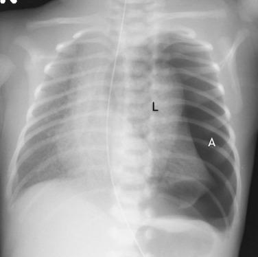 Fig. 18.8, Tension pneumothorax. Air (A) fills the left pleural space and causes compressive atelectasis of the left lung (L) and midline shift rightward.