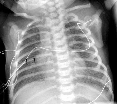 Fig. 18.9, Transient tachypnea of the newborn. Anteroposterior chest radiograph shows bilateral symmetric interstitial fluid and pleural fluid (arrows). Normal heart size.
