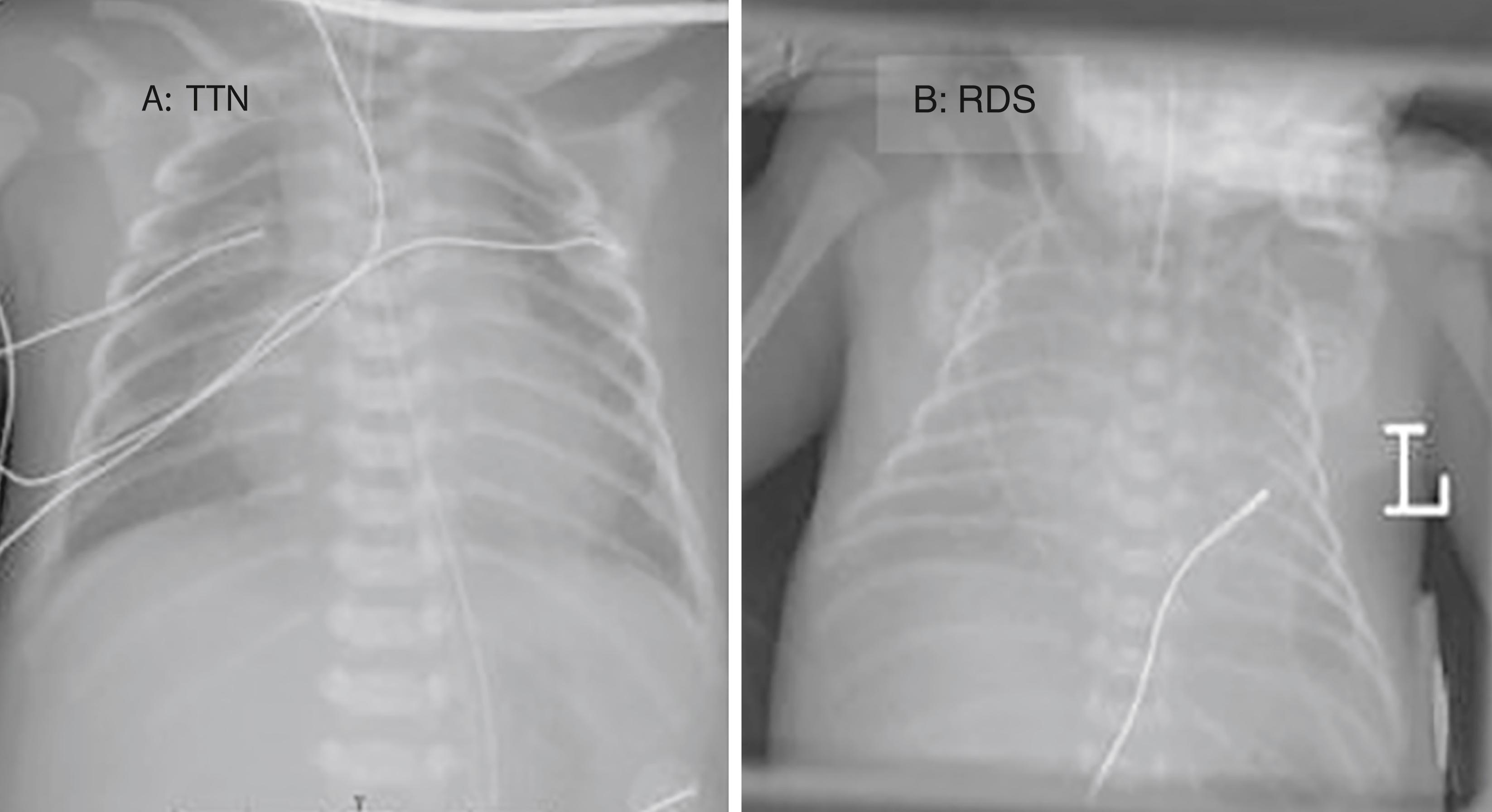 Figure 73.2, Chest x-ray appearance of transient tachypnea of the newborn (TTN) (A) and respiratory distress syndrome (RDS) (B). The radiographic characteristics of TTN include perihilar densities with good aeration, bordering on hyperinflation. In contrast, neonates with RDS have diminished lung volumes on chest x-ray reflecting atelectasis associated with surfactant deficiency. Diffuse “ground glass” infiltrates along with air bronchograms make the cardiothymic silhouette indistinct.