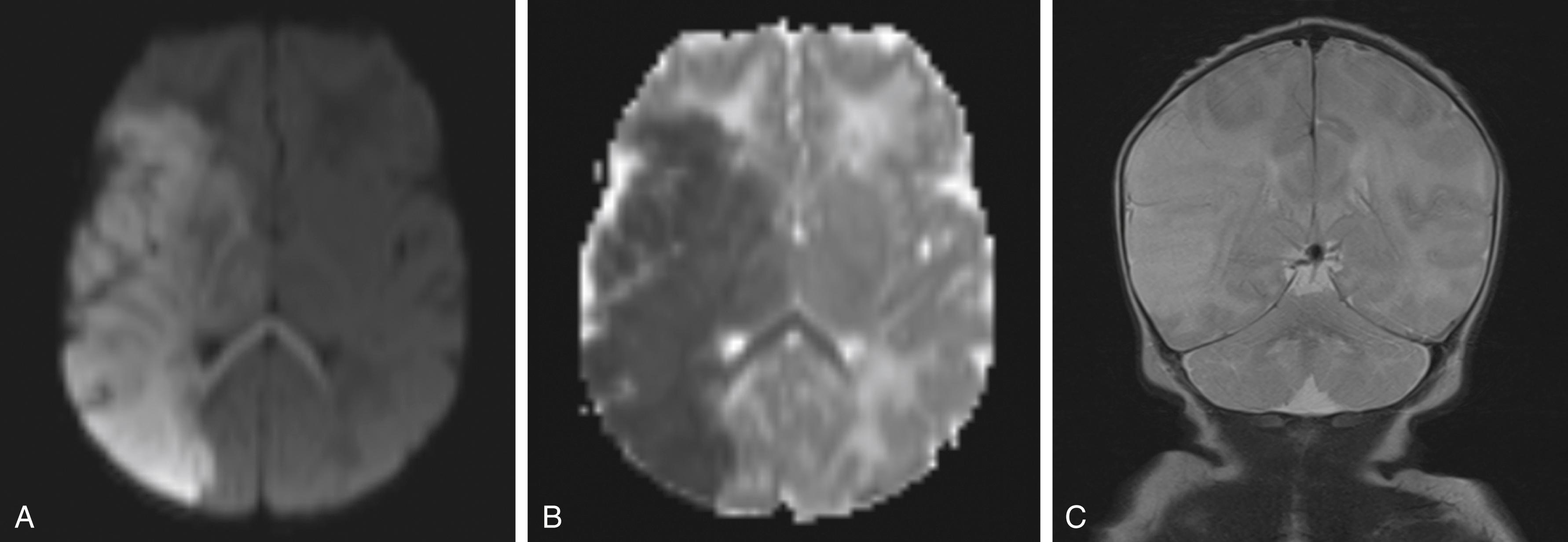 Fig. 56.1, A 4-Day-Old Term Male Neonate With Right Middle Cerebral Artery Stroke.