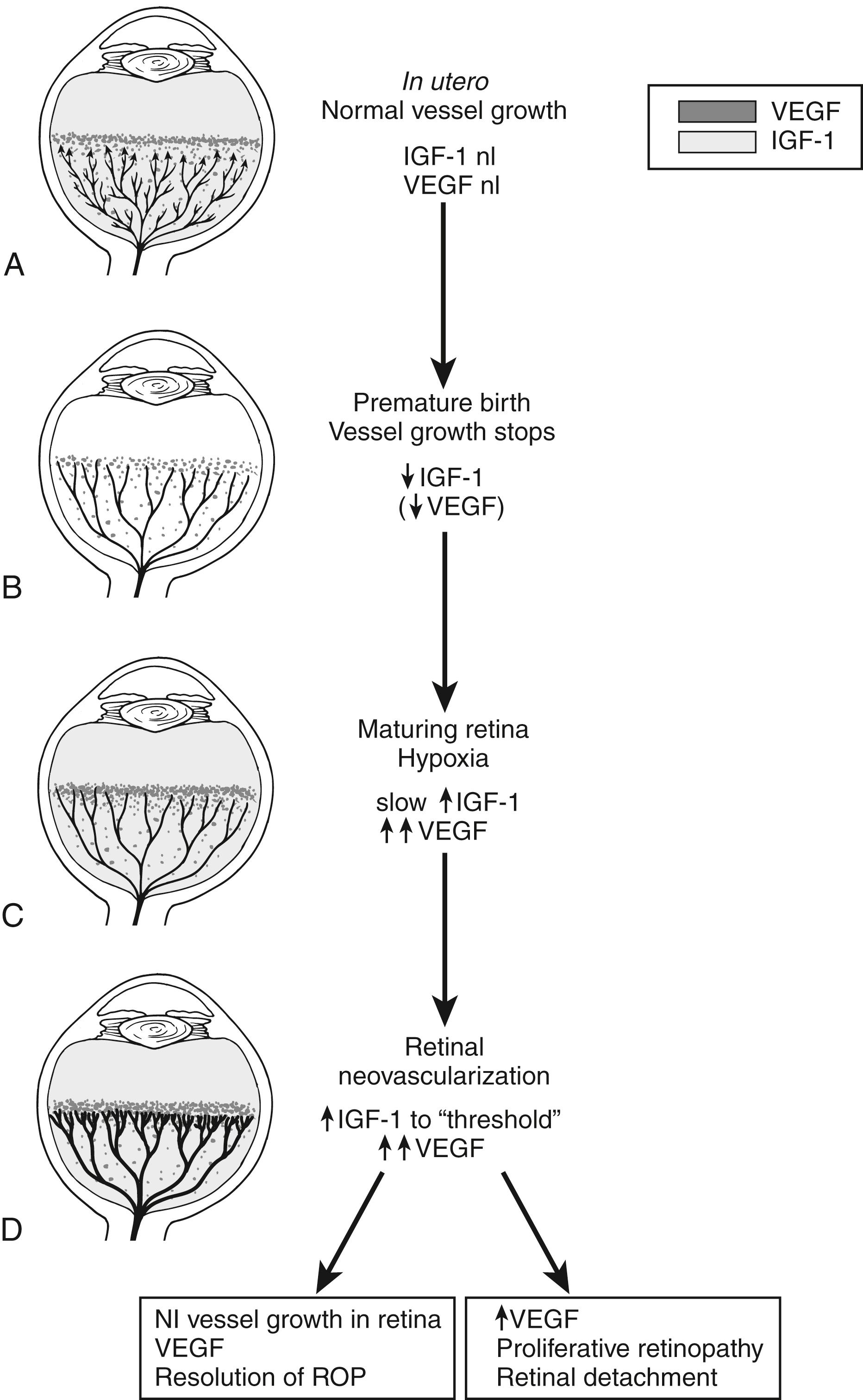 Figure 15-1, Schematic representation of IGF-1/VEGF control of blood vessel development in ROP. A, In utero, VEGF is found at the growing front of vessels. IGF-1 is sufficient to allow vessel growth. B, With premature birth, IGF-1 is not maintained at in utero levels, and vascular growth ceases despite the presence of VEGF at the growing front of vessels. Both endothelial cell survival (AKT) and proliferation (MAPK) pathways are compromised. With low IGF-1 and cessation of vessel growth, a demarcation line forms at the vascular front. High oxygen exposure (as occurs in animal models and in some premature infants) may also suppress VEGF, further contributing to inhibition of vessel growth. C, As the premature infant matures, the developing but nonvascularized retina becomes hypoxic. VEGF increases in retina and vitreous. With maturation, the IGF-1 level slowly increases. D, When the IGF-1 level reaches a threshold at 34 weeks’ gestation, with high VEGF levels in the vitreous, endothelial cell survival and proliferation driven by VEGF may proceed. Neovascularization ensues at the demarcation line, growing into the vitreous. If VEGF vitreal levels fall, normal retinal vessel growth can proceed. With normal vascular growth and blood flow, oxygen suppresses VEGF expression, so it will no longer be overproduced. If hypoxia (and elevated levels of VEGF) persists, further neovascularization and fibrosis leading to retinal detachment can occur.