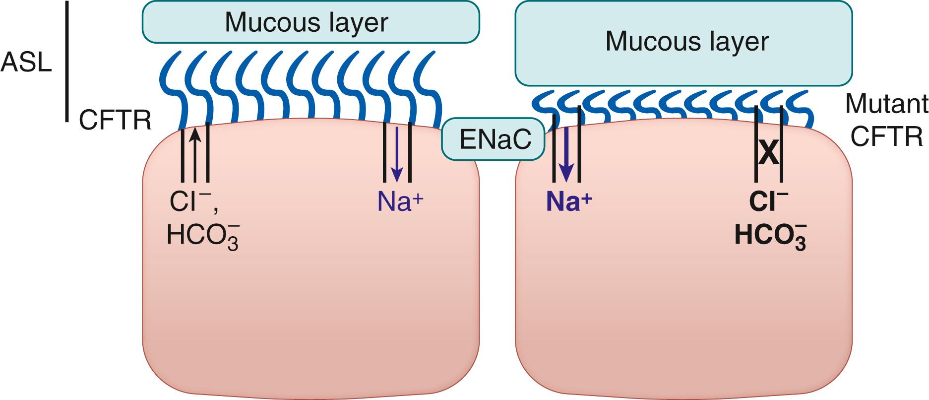 Fig. 123.3, Regulation of the airway surface liquid (ASL) by cystic fibrosis transmembrane conductance regulator (CFTR) . The ASL is regulated by active ion transport across the epithelial cells with concomitant fluid movement that is either passive or aquaporin regulated. CFTR regulates both Cl − and HCO 3 − transport, and along with the epithelial sodium channel (ENaC) regulates the height of the ASL. Disease-causing mutations of the CFTR result in defective Cl − and HCO 3 − conductance and reduction of the ASL. This leads to ciliary dysfunction and mucous impaction.