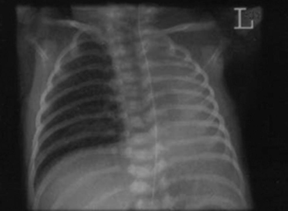 Fig. 66.1, Unilateral left lung agenesis.