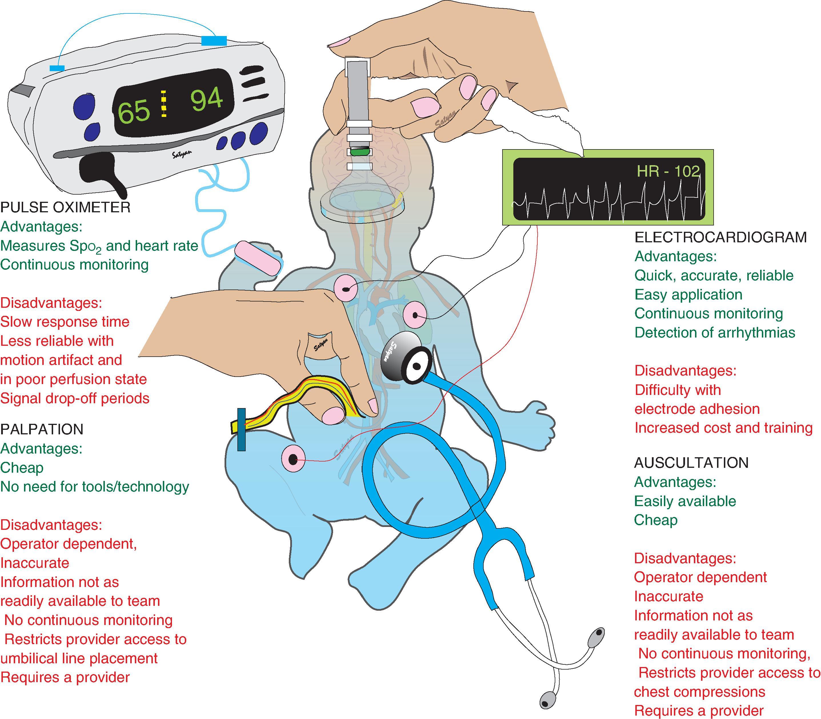 Fig. 8.5, Methods of Heart Rate Assessment in the Delivery Room .