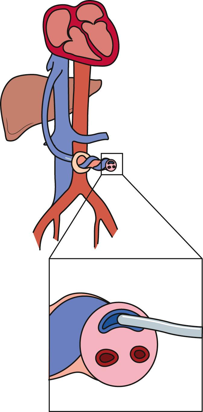 Fig. 121.3, Emergently placed umbilical venous catheter suitable for neonatal resuscitation.