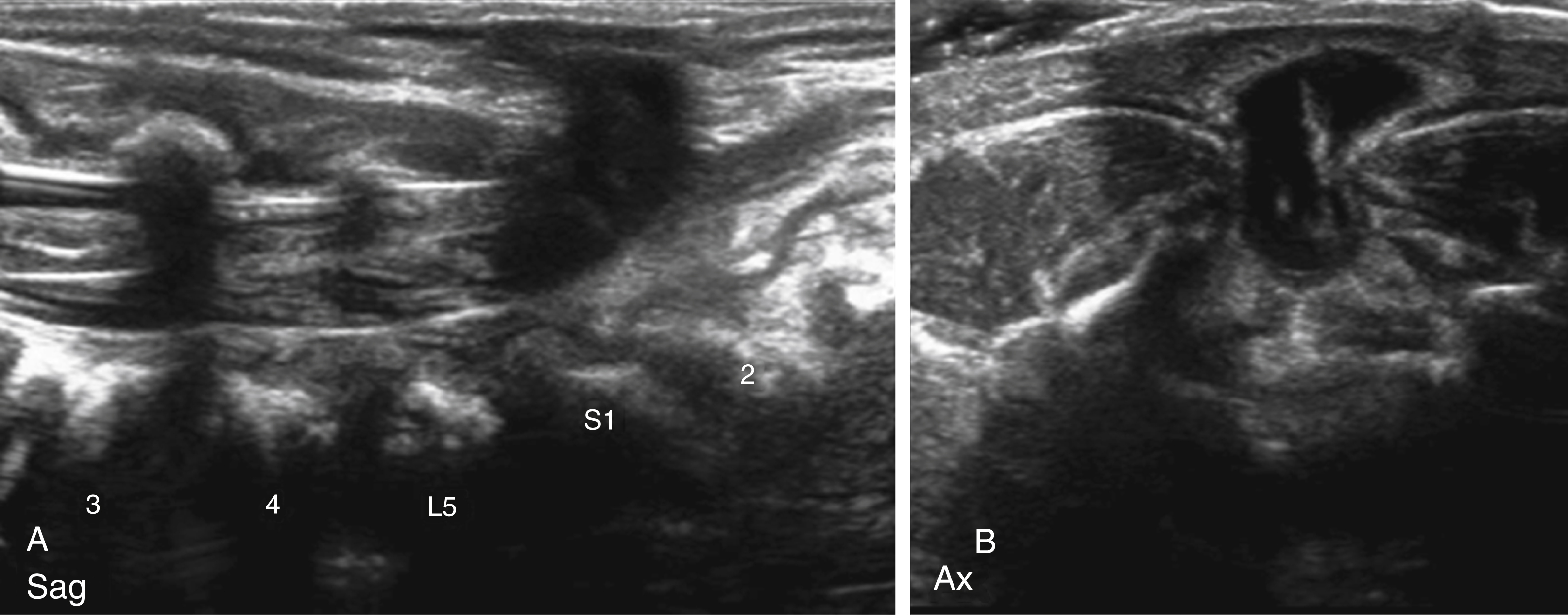 Fig. 29.2, Postnatal sagittal (A) and axial (B) ultrasound images of a neonate with a myelomeningocele. The cerebrospinal fluid-filled hypoechogenic myelomeningocele sac is identified with the neural placode on top of the myelomeningocele sac. The nerve roots are seen as linear hyperechogenic structures coursing through the widened spinal canal. A standoff pad is positioned on top of the neural placode to enhance the image quality, simulating superficial soft tissue.