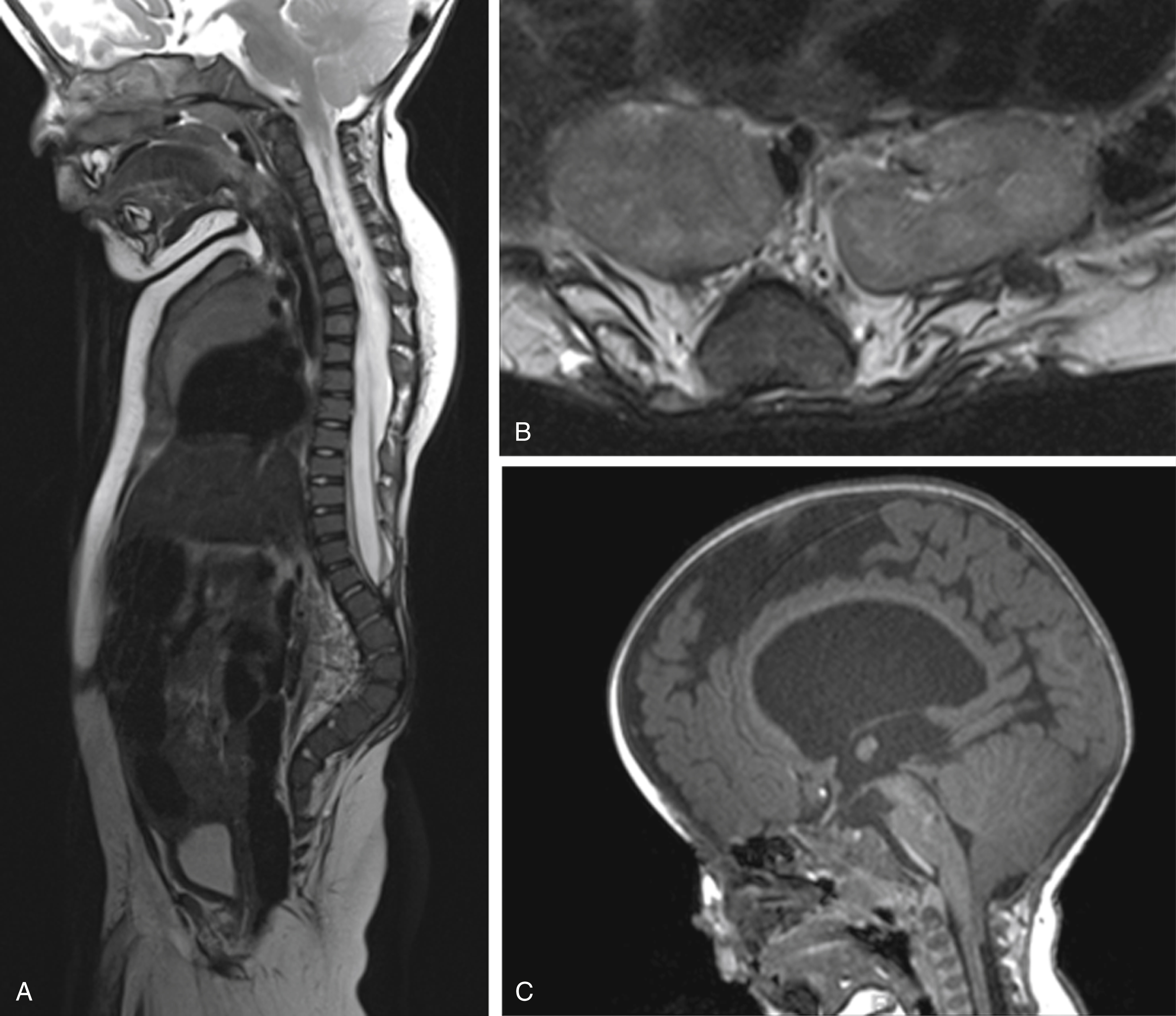 Fig. 29.3, Sagittal (A) and axial (B) T2-weighted magnetic resonance (MR) images of the spinal canal of a neonate with repaired thoracolumbar myelomeningocele. The spinal cord is hypoplastic/thinned, the dorsal soft tissue and bony elements are completely lacking at the level of the spinal dysraphia, the skin was closed surgically over the defect. No dorsal musculature is seen. The kidneys are partially malrotated and approach each other in the midline anterior to the vertebral body. The sagittal T1-weighted MR image of the brain (C) shows the classical stigmata of a Chiari type II malformation.