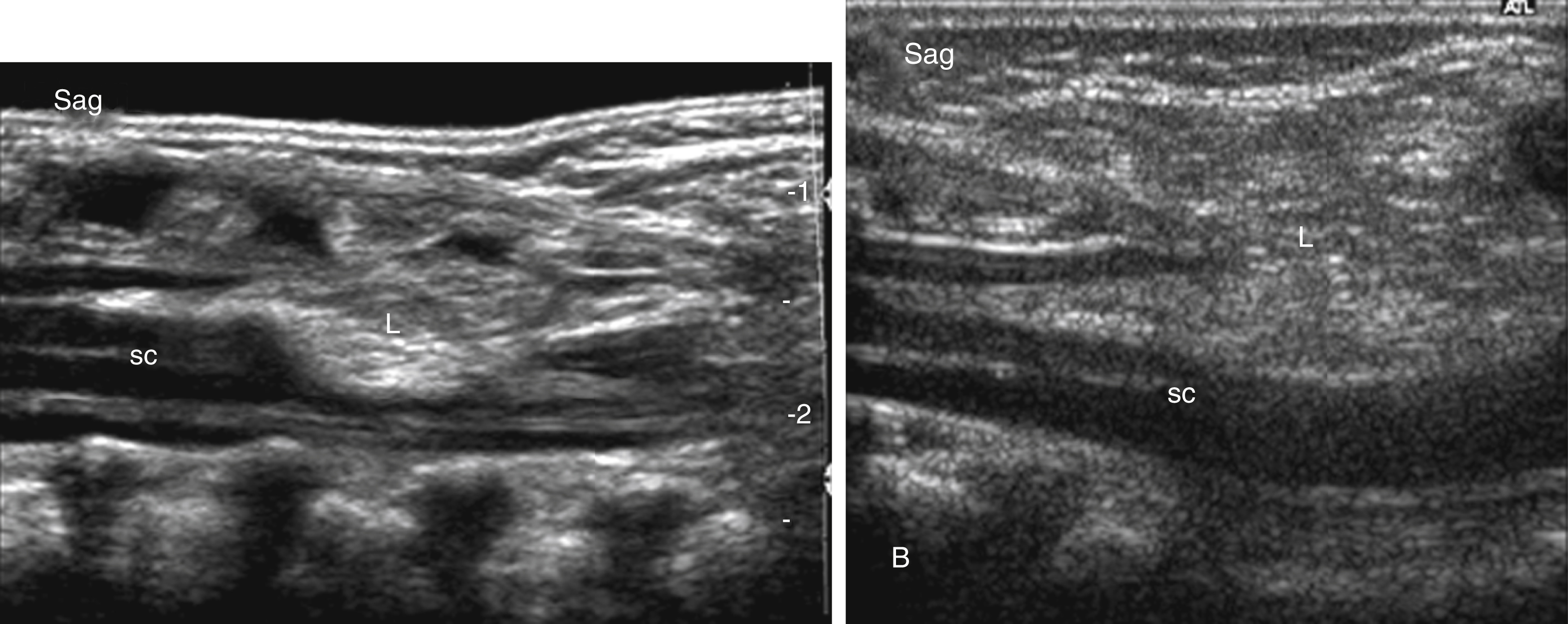 Fig. 29.5, Sagittal ultrasound images of two neonates (A,B) with large lumbar lipomyelomeningoceles. The spinal cord (sc) is tethered and the distal neural placode is covered by hyperechogenic lipoma (L) extending into the subcutaneous region.