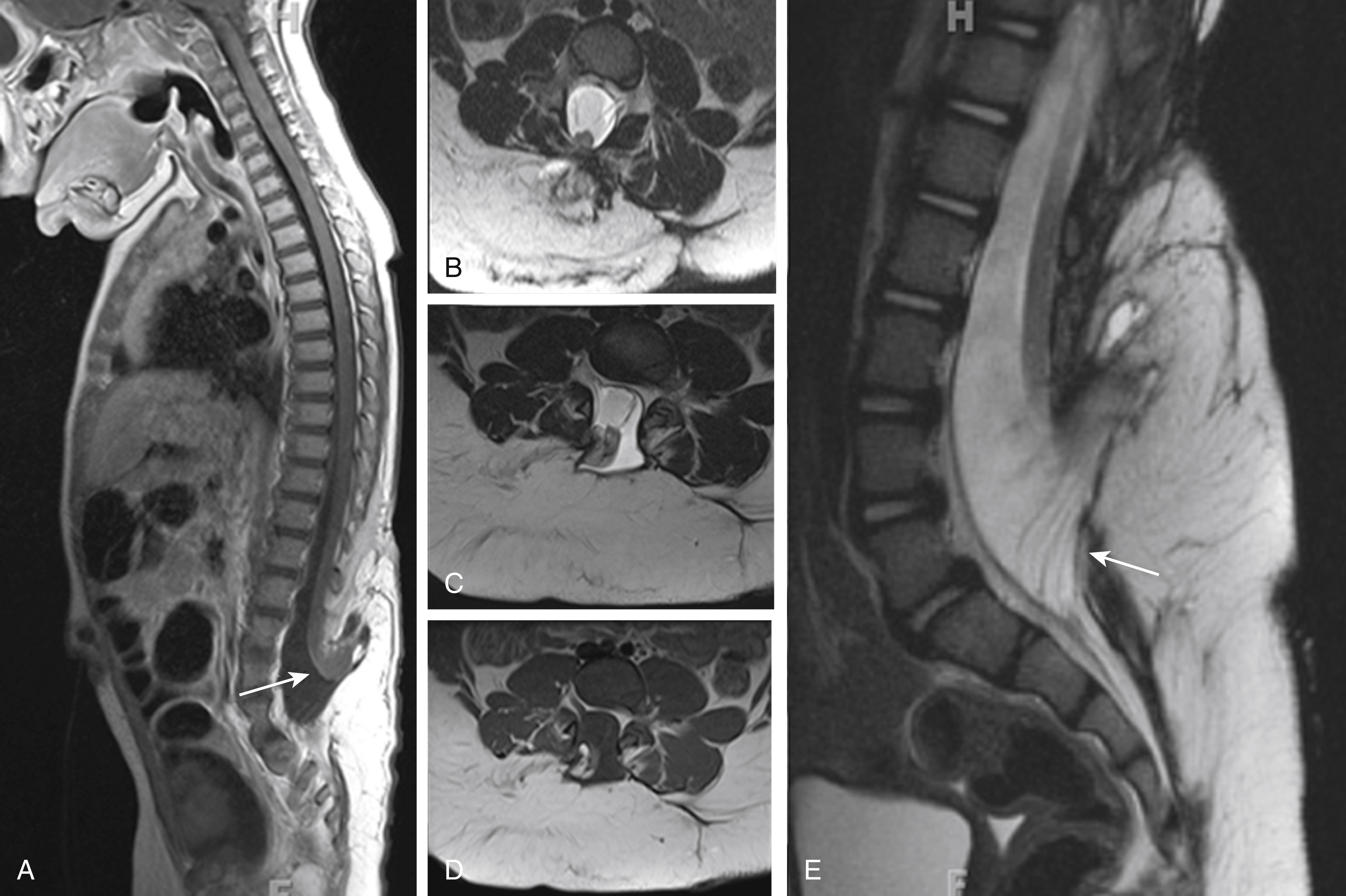 Fig. 29.6, (A) Sagittal T1-weighted (left image), (B,C) axial T2-weighted (middle, upper two images), (D) axial T1-weighted (middle, lower image), and (E) magnified sagittal T2-weighted (right image) magnetic resonance images of a neonate with a skin-covered lumbar lipomyelomeningocele. The neural placode is herniating outside of the widened spinal canal and is dorsally covered by a T2/T1-hyperintense lipoma that is extending from the subcutaneous region into the widened spinal canal. The neural placode is partially rotated. The anterior and posterior nerve roots are located along the anterior surface of the neural placode and are seen as thin, stretched nerves coursing through the cerebrospinal fluid-filled dural sack ( arrow ). The musculature is rather well developed; no Chiari type II malformation was seen.
