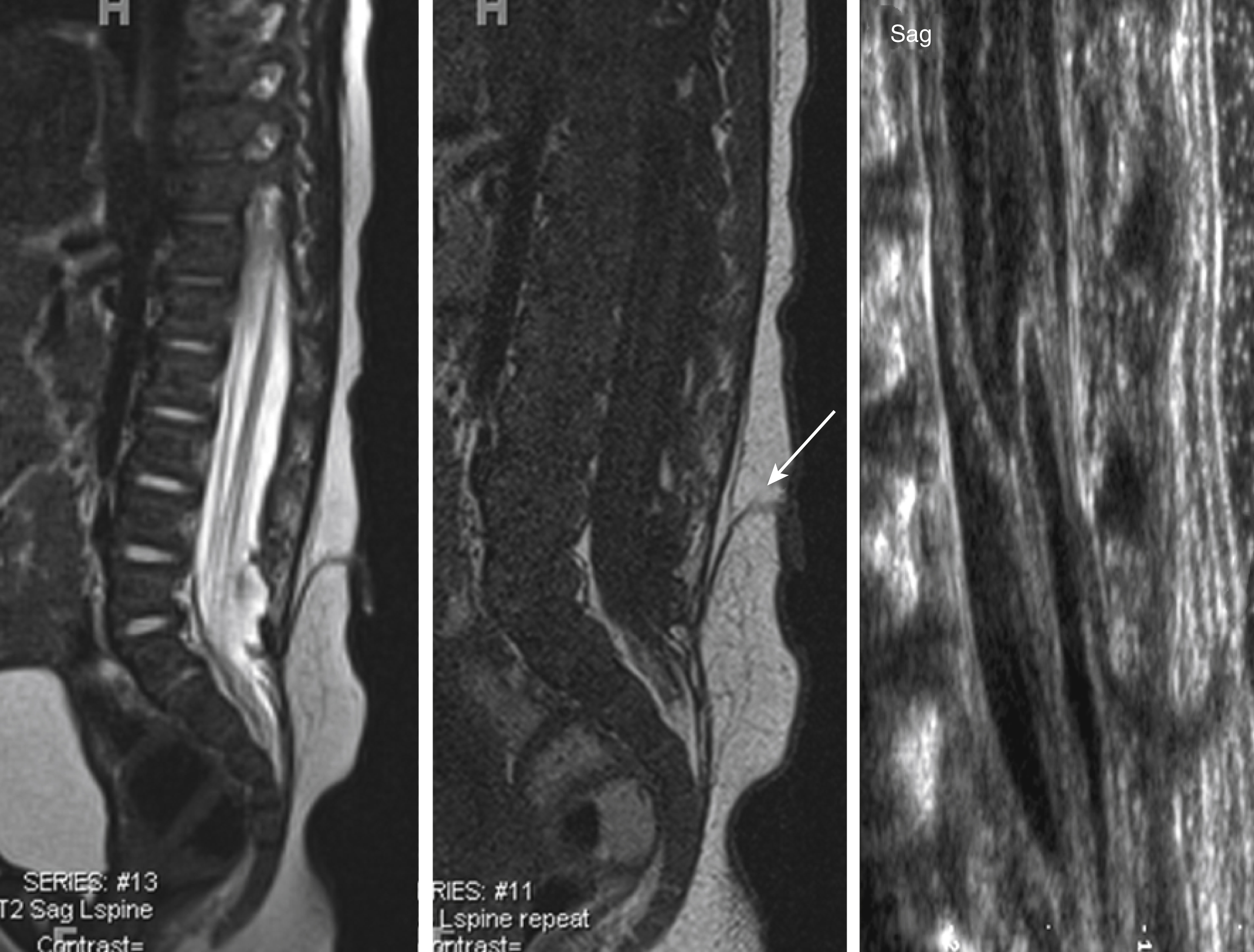 Fig. 29.7, Sagittal T2 (left), T1 (middle) magnetic resonance, and ultrasound (right) images of a neonate with a dorsal dermal sinus. The fistulous tract is seen extending from the skin through the subcutaneous tissue into the spinal canal. The fistulous tract is outlined by T1/T2-hyperintense fat. The lesion is equally well seen on ultrasound as a hypoechogenic tract.