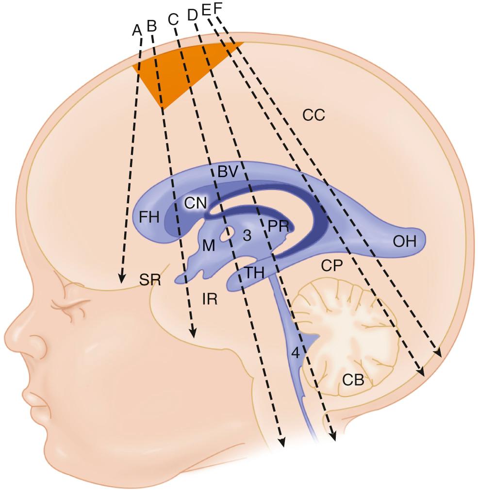 FIG. 45.1, Coronal Brain Ultrasound Planes Through Anterior Fontanelle.