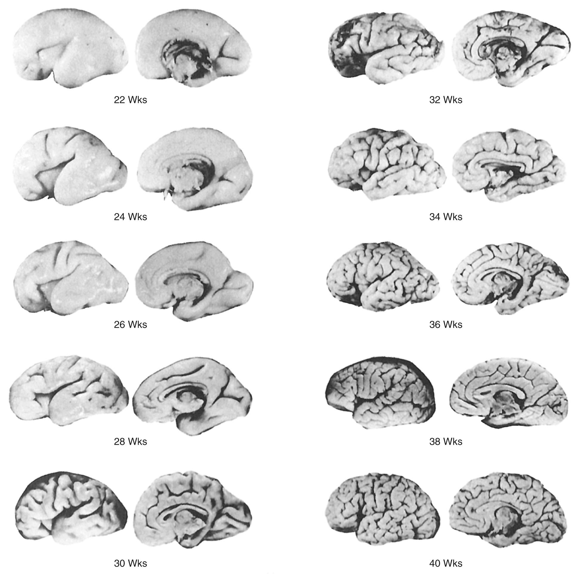 FIG. 45.11, Normal Sulcal Pattern Development.