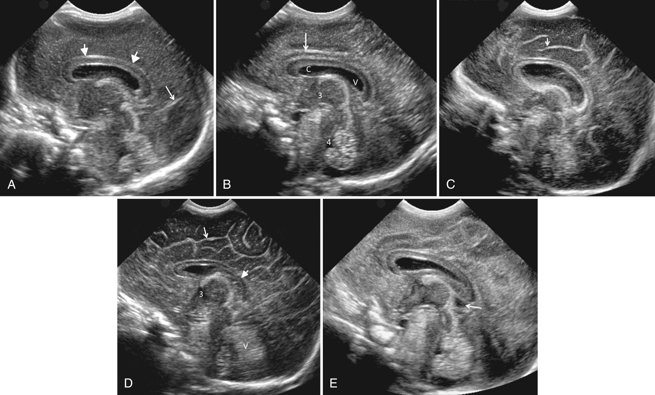 FIG. 45.12, Development of Sulci in a Premature Infant Brain.