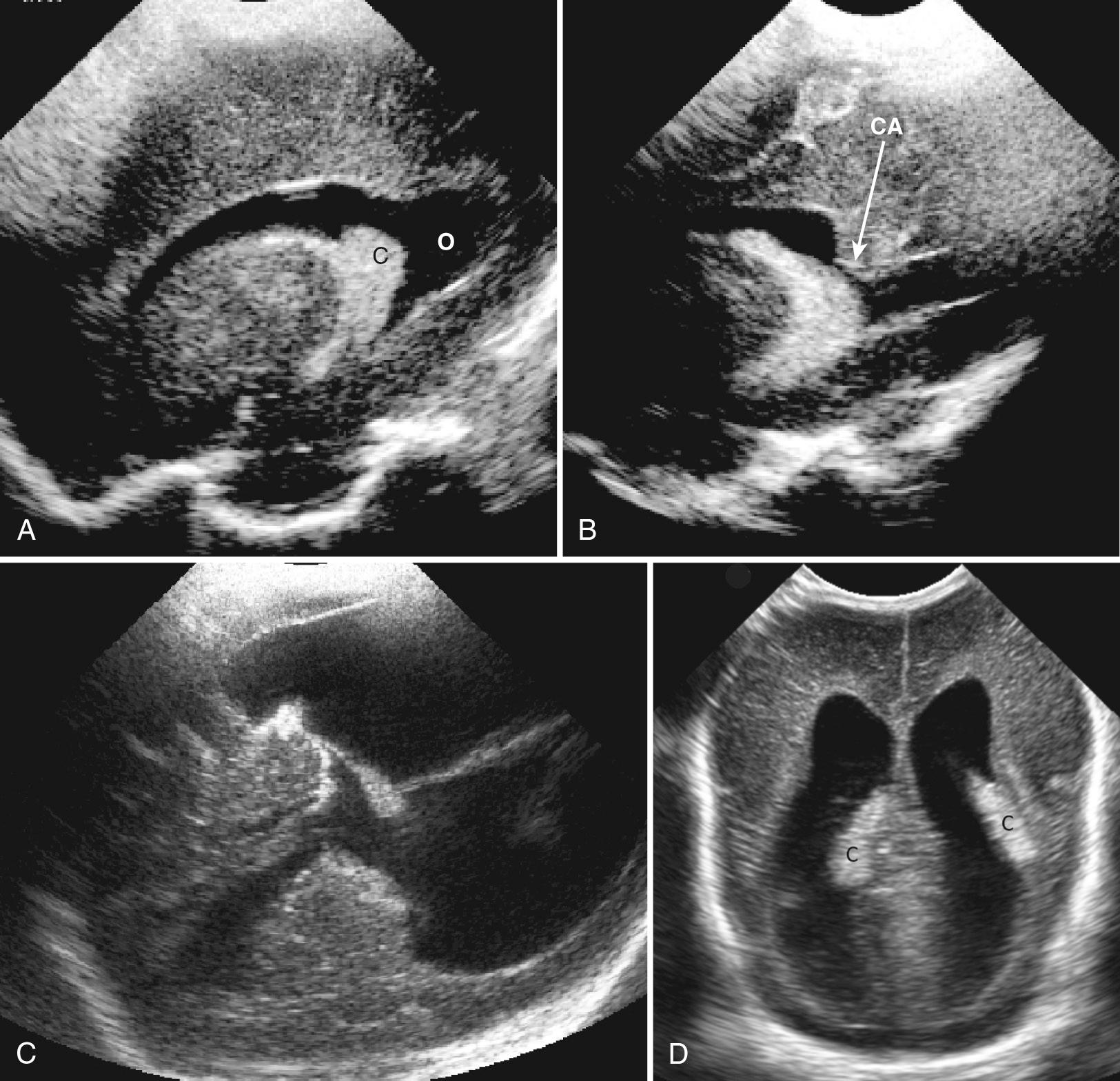 FIG. 45.16, Choroid Plexus and Calcar Avis.