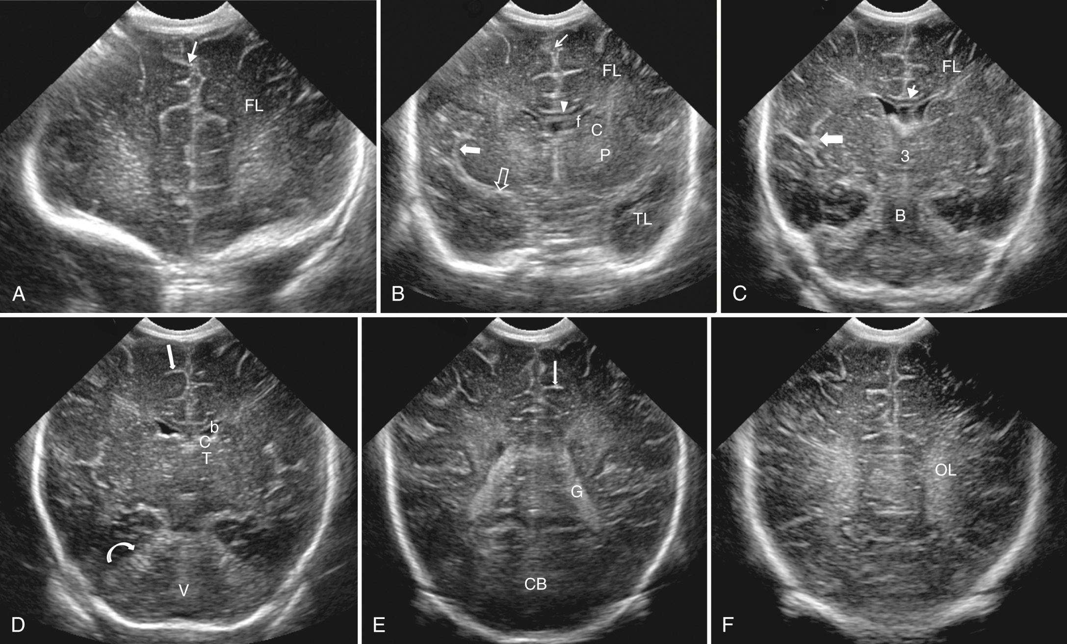 FIG. 45.2, Normal Coronal Brain Images: Full-Term Infant.