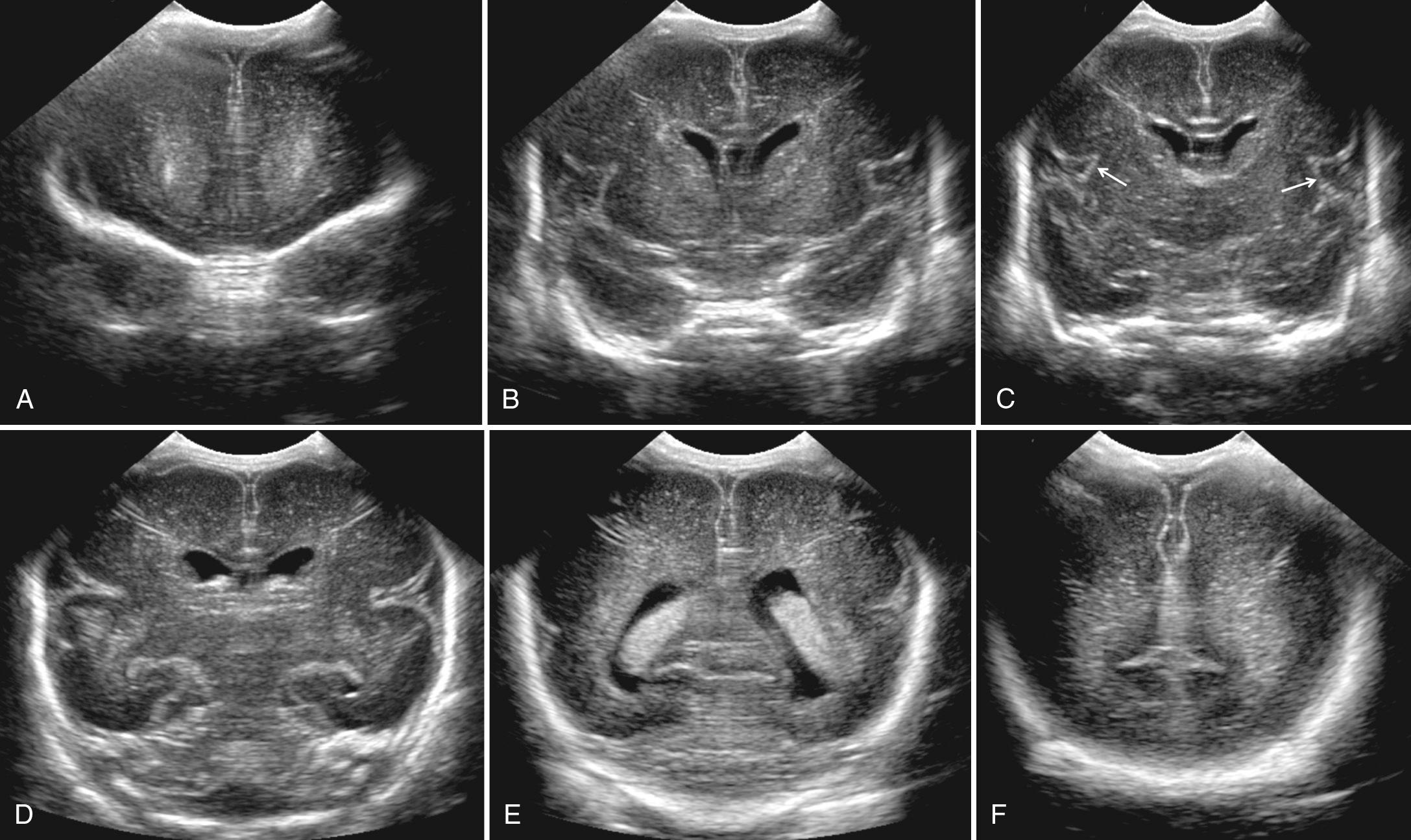 FIG. 45.3, Normal Coronal Brain Images: Premature Newborn Infant.