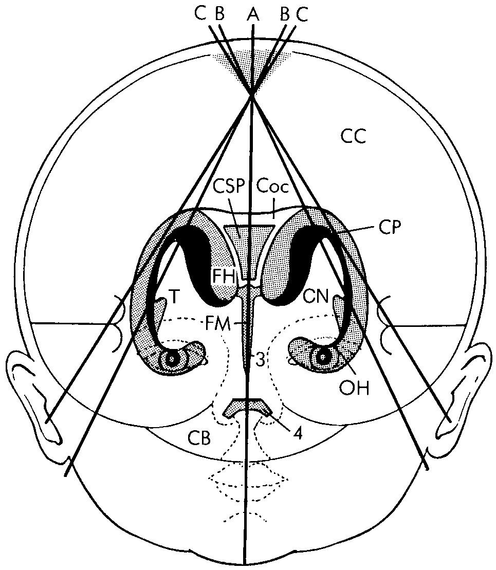 FIG. 45.4, Sagittal Planes Used in Brain Scanning Through Anterior Fontanelle.