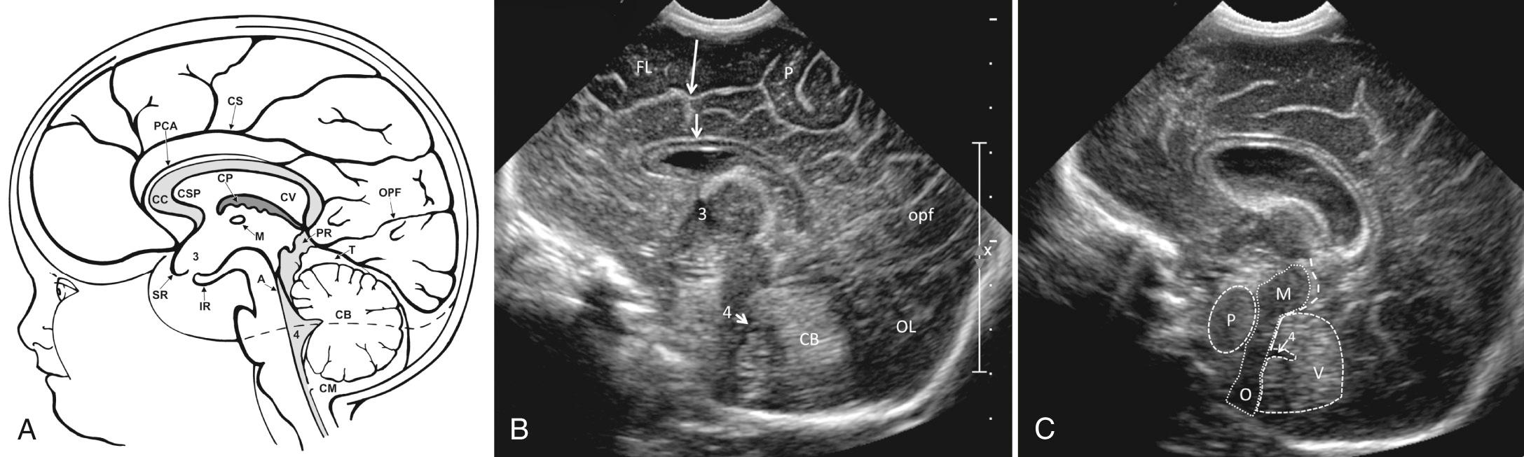 FIG. 45.5, Normal Midline Sagittal Anatomy.