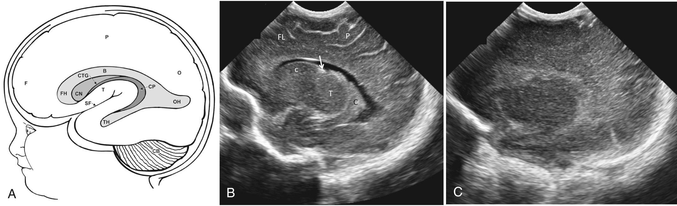 FIG. 45.6, Normal Paramedian Sagittal Anatomy.